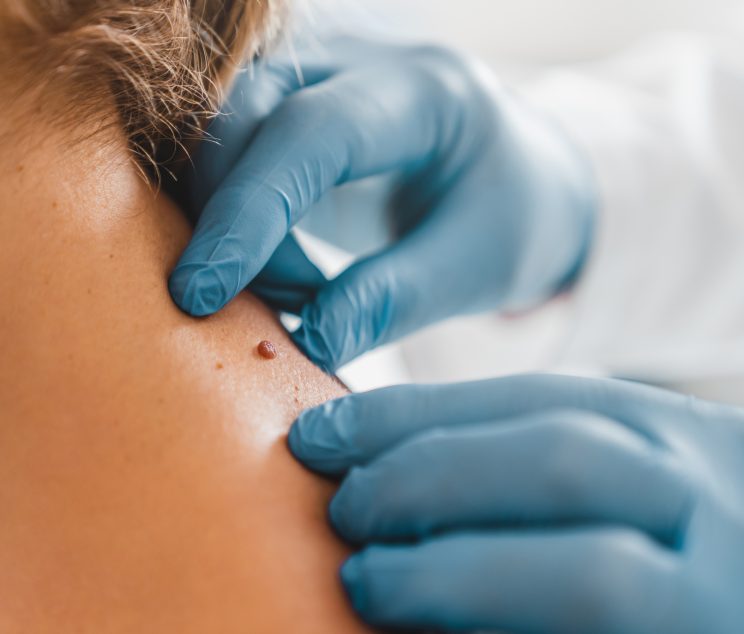 Close up of dermatologist examining patient birthmark in clinic